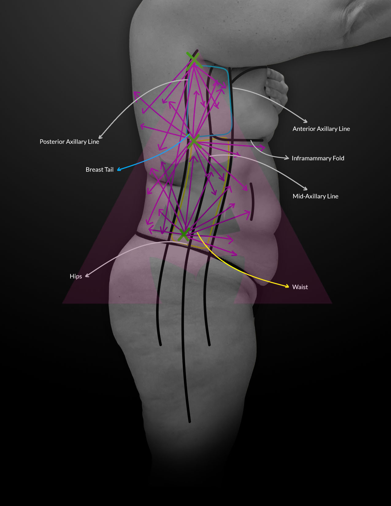 Where should the incisions for Lipo / BBL be placed? (photos)