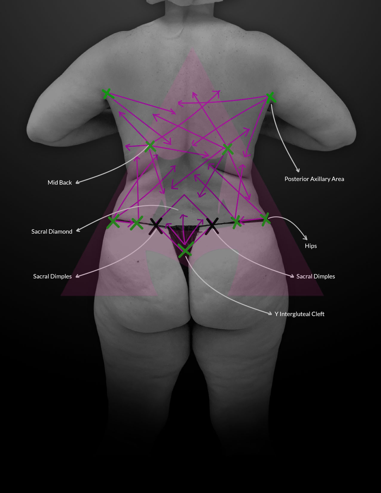 Where should the incisions for Lipo / BBL be placed? (photos)