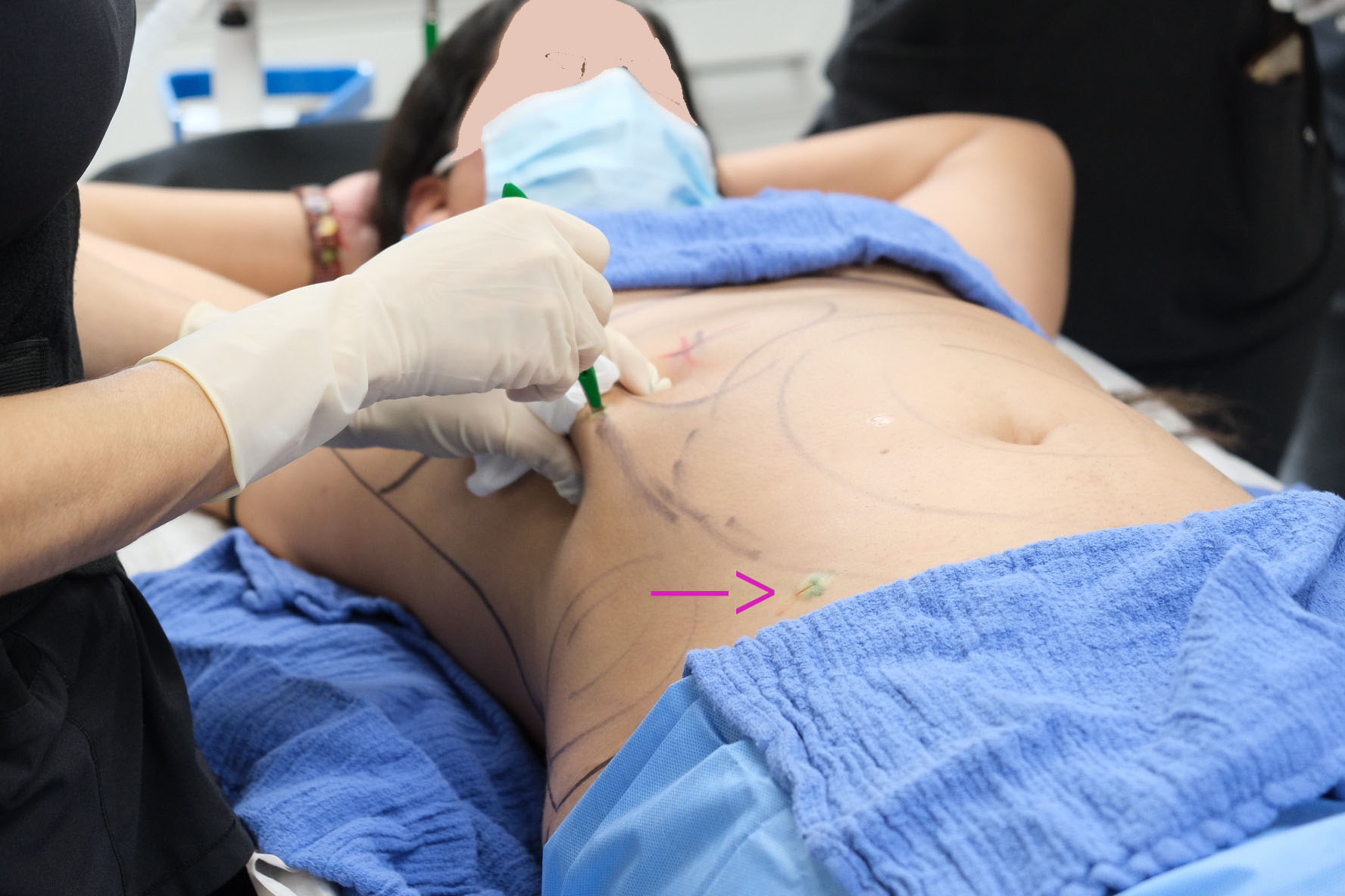 Pearls of Wisdom: Abdominal, Waist and Back Lipo Incisions